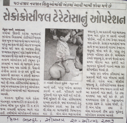 Operation of Sacrococcygeal Teratoma